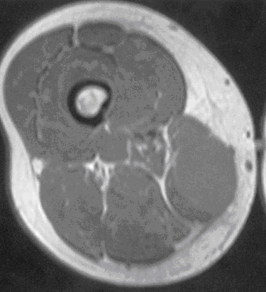 Liposarcoma Pathology Orthobullets